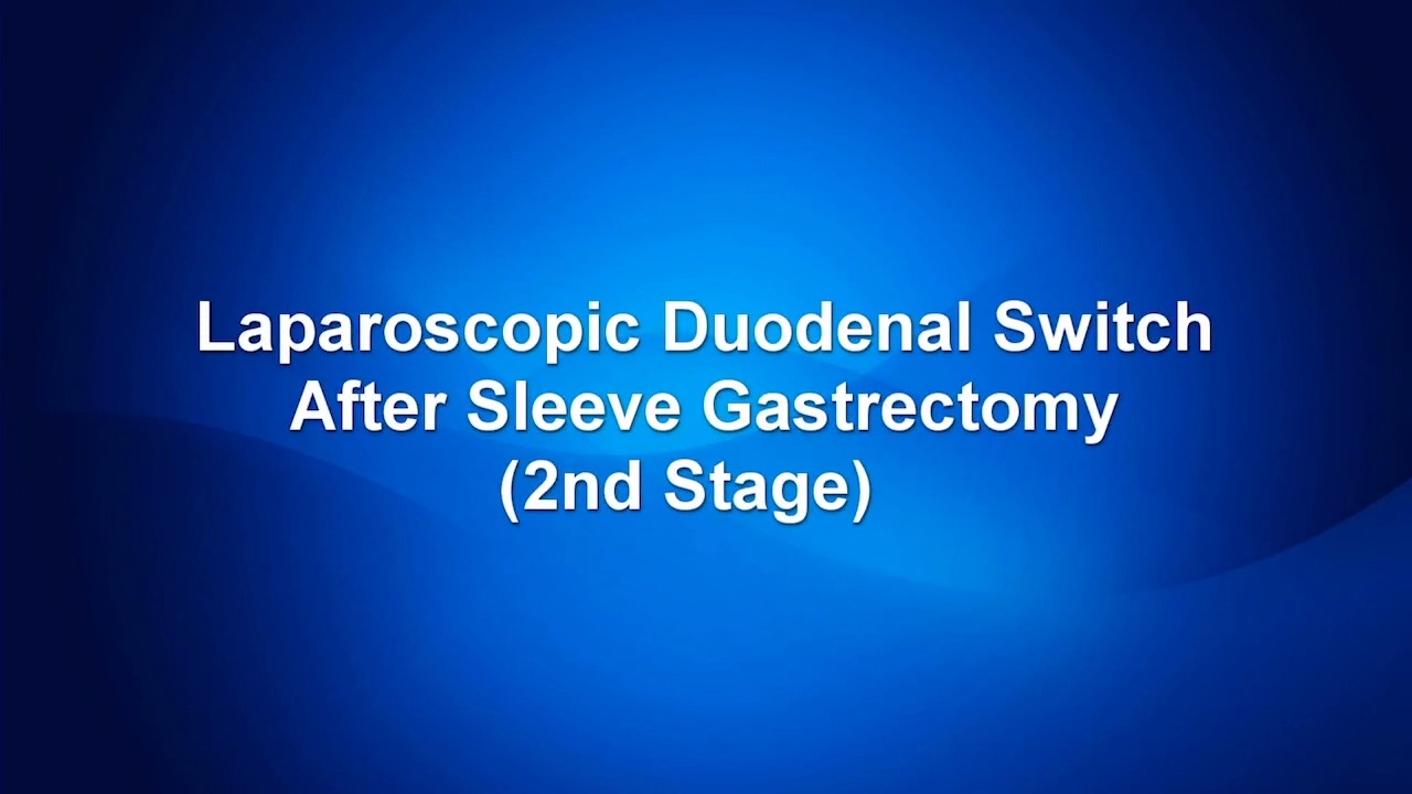 Laparoscopic Duodenal Switch After Sleeve Gastrectomy (2nd Stage ...