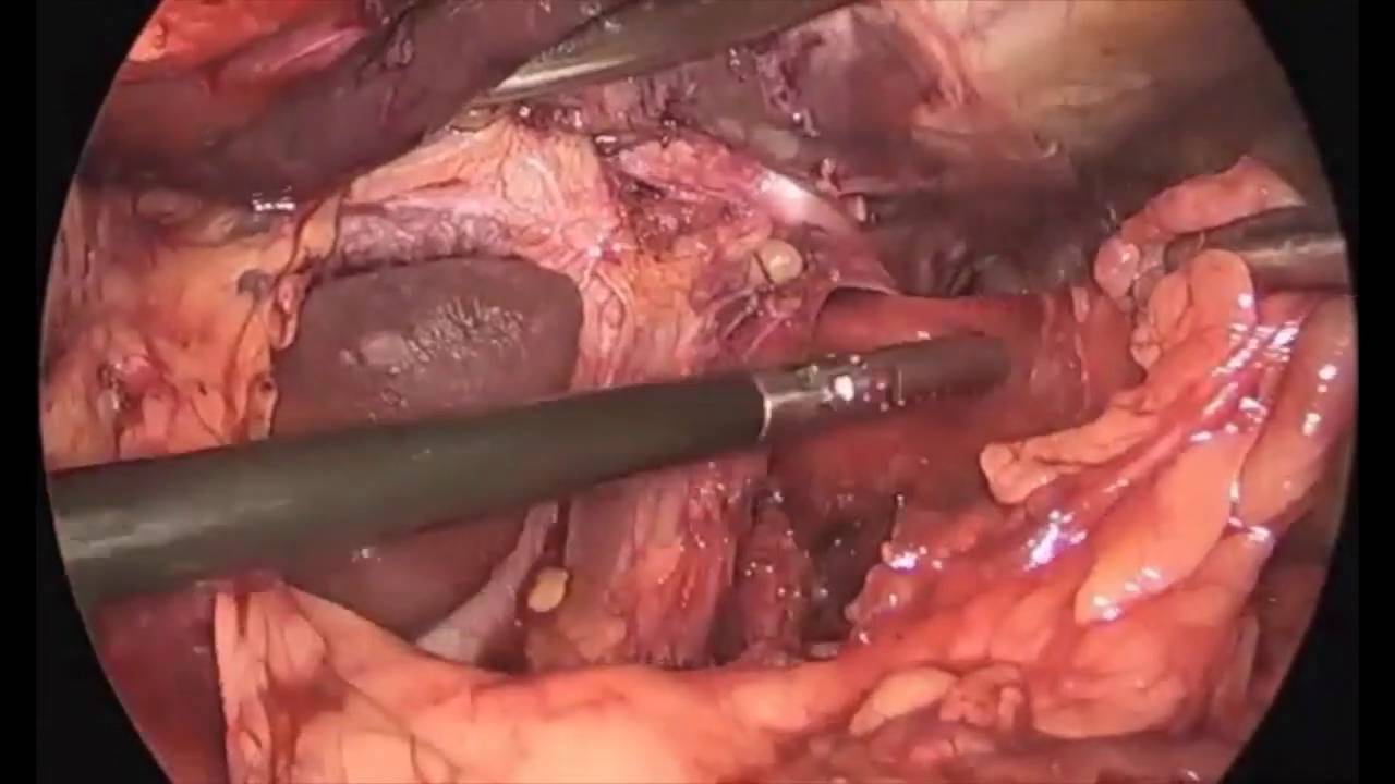 Laparoscopic Revision Of Chronic Marginal Ulcer And Bilateral Truncal