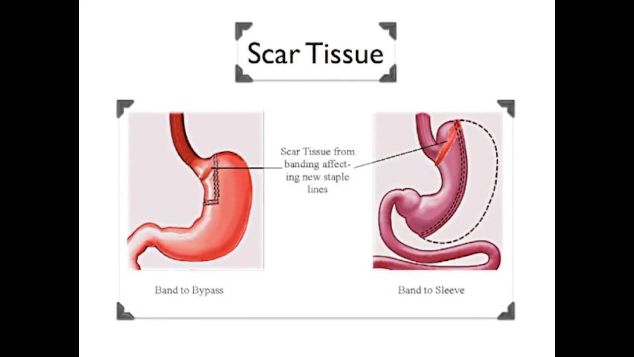 Conversion of laparoscopic sleeve gastrectomy (lsg) to rouxeny