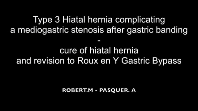 Type 3 Hiatal Hernia Complicating A Mediogastric Stenosis After Gastric Banding Cure Of Hiatal