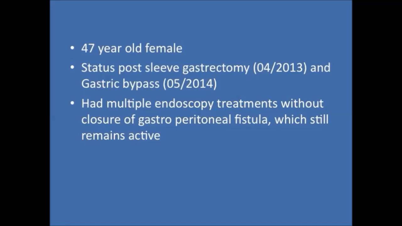 Laparoscopic esophagojejunostomy for RYGB after leak from Sleeve