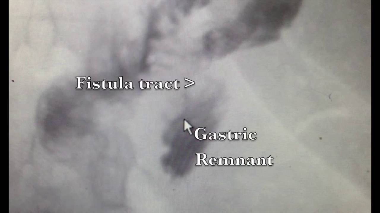 Candy cane roux limb to gastric remnant fistula following gastric