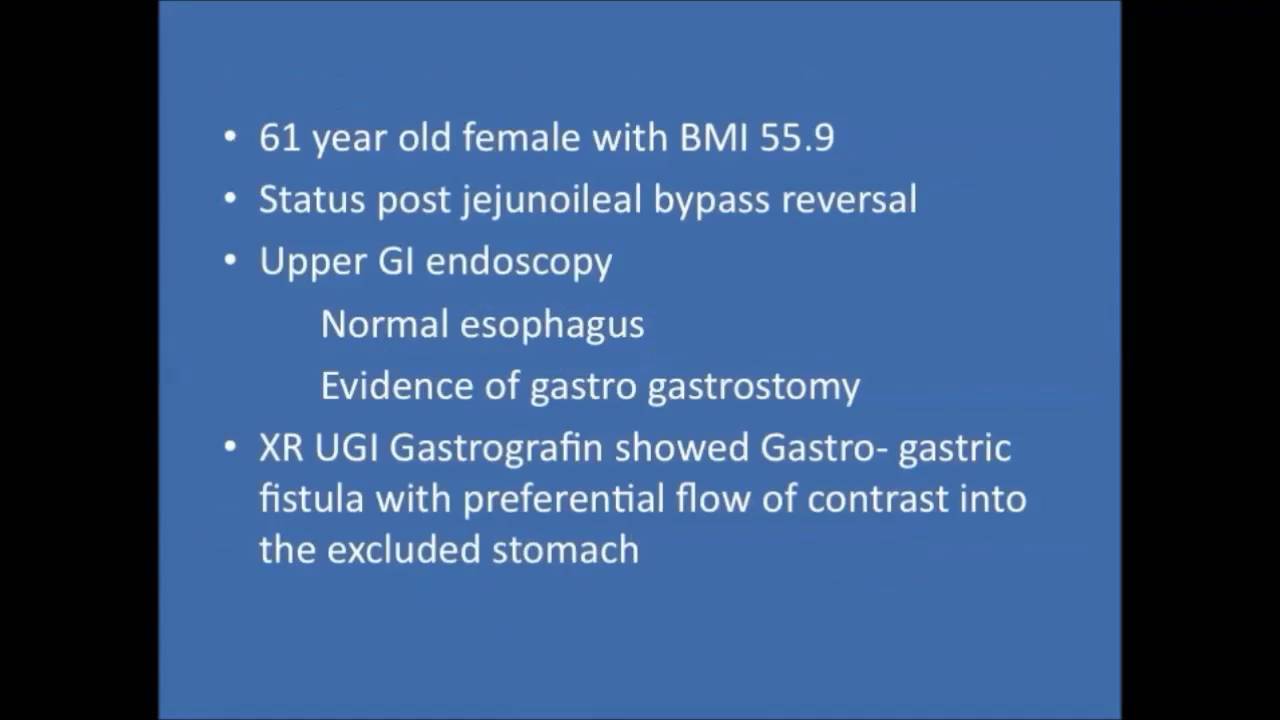 Laparoscopic rouxeny gastric bypass (lrygb) after loop gastric bypass